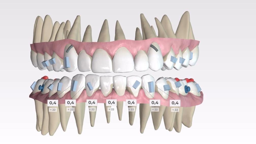 SPARK aligners beugel orthodontie 