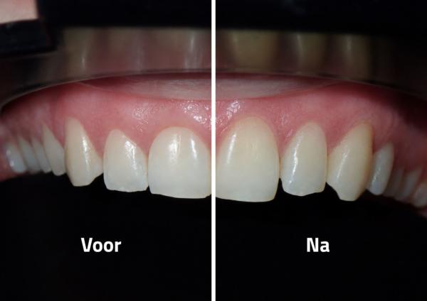 Laseren voor en na