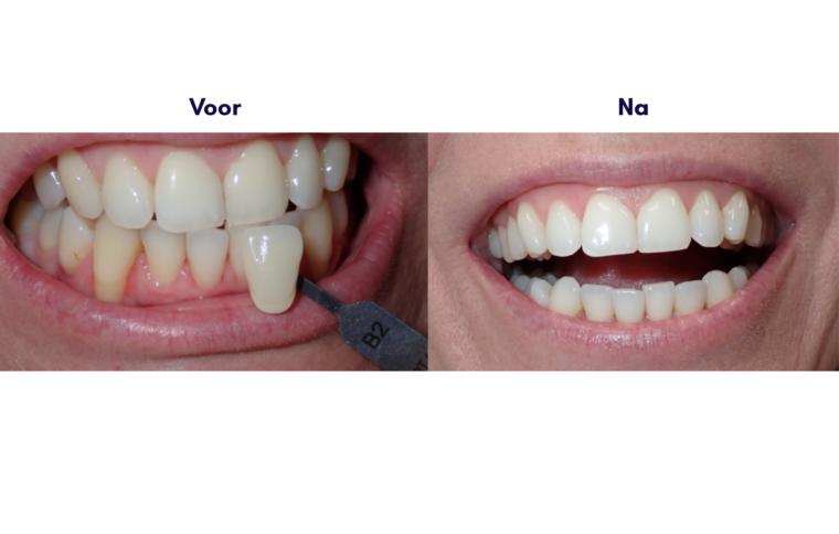 Voor